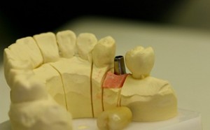 Implantat, dient als künstliche Zahnwurzel zur Befestigung von Kronen, Brücken oder Prothesen.